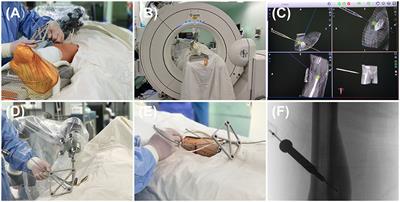 O-Arm-Navigated, Robot-Assisted Versus Conventional CT Guided Radiofrequency Ablation in Treatment of Osteoid Osteoma: A Retrospective Cohort Study